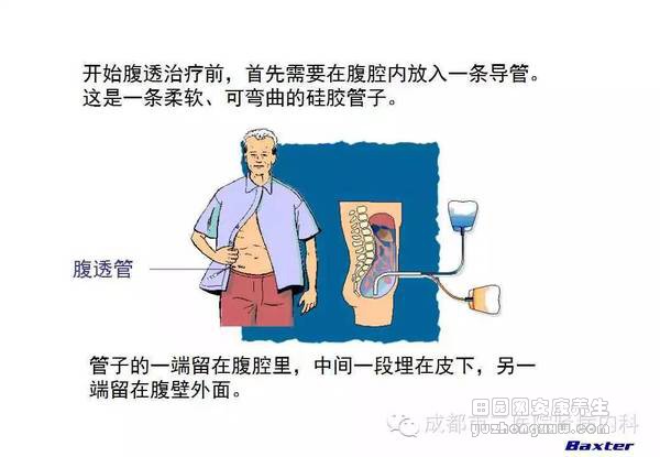 科普：血液透析和腹膜透析