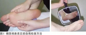 糖尿病足部自我检查和日常护理