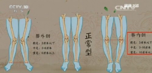 《健康之路》20161215曹永平《腿部变形记》运动处方、改变腿形减轻疼痛的方法