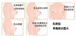 乳腺癌的早期症状