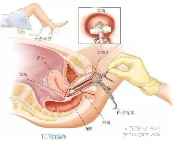 妇科体检项目，该怎么选？