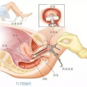 妇科体检项目，该怎么选？