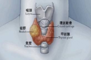 甲状腺结节，哪些是良性、哪些是恶性？