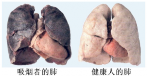 《科普》长期吸烟对“肺”的伤害有多大？