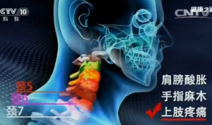 《健康之路》20161223《调脊柱保健康（上）》颈椎自我保健操、中药热敷