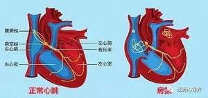 房颤的特点、致病因和心室率的控制