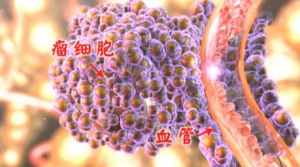 北京卫视20161225《养生堂》、李辉《防癌秘诀家中寻-3》肺癌、肺转移、肺癌的筛查