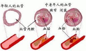 脑梗塞的病因是什么？