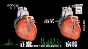 《健康之路》20170112华伟《心跳会说话》心动过速、室颤、房颤