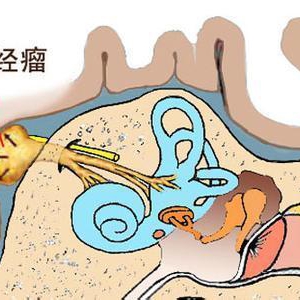 听神经瘤恶化速度慢，早期难以察觉，几种症状应警惕