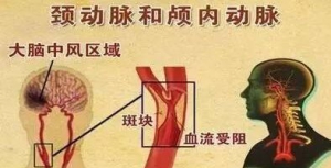 《科普》颈动脉斑块的危害
