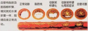 《科普》颈动脉斑块，是如何形成的？