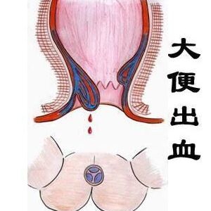 肛门疼痛常见有哪些疾病？