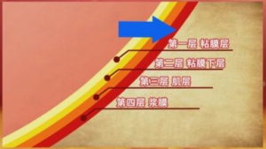 《养生堂》20170223肖刚《填平胃里的“火山口”》胃黏膜损伤的危害
