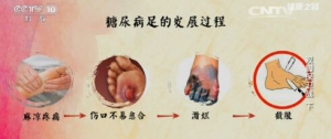 《健康之路》20170302徐旭英《双脚保卫战（下）》糖尿病足的预防