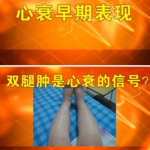 《养生堂》20170316汪芳《警惕要命的腿肿 》心衰、猝死、下肢深静脉血栓