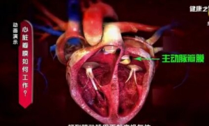 《健康之路》20170410吴永健《别让心脏老得快》瓣膜性心脏病、瓣膜病