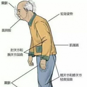 《健康之路》20170411杨玉明《小心帕金森病找上你》帕金森病的症状与治疗