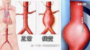 《健康之路》20170526刘鹏《血管堵了该咋办》腹主动脉瘤