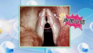 《健康之路》20171031《听声音 辨疾病》声音嘶哑背后的4重危机