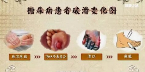 《健康之路》20180206《小伤口莫小视》糖尿病足、敷脚方、三子除痹汤
