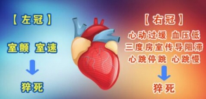 《养生堂》20180516心绞痛、冠状动脉狭窄、硝酸甘油、血管痉挛