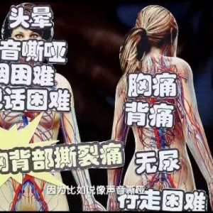 《健康之路》20180604刘中民、主动脉瘤的症状、筛查与治疗