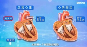 《健康之路》20180606房颤、心慌、气短、胸闷、濒死感、尿频、头晕乏力