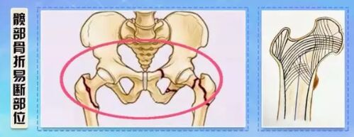 髋部骨折易断部位