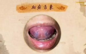 《健康之路》20180810血瘀舌象、如何辨别血瘀？如何预防血瘀？