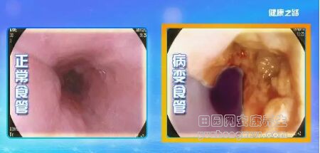 《健康之路》20180904食道癌病发前的3个“红灯”