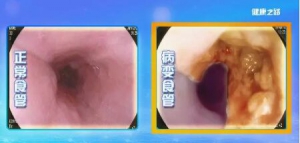 《健康之路》20180904食道癌病发前的3个“红灯”