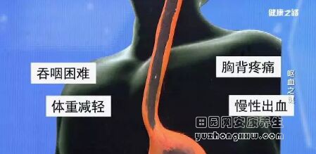 《健康之路》20180904食道癌病发前的3个“红灯”