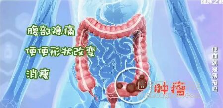 《健康之路》20181020肠癌、肛瘘、溃疡性结肠炎、痔疮、肠息肉