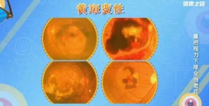 《健康之路》20181115陈有信、黄斑变性、老花眼、康柏西普