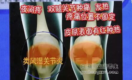 《健康之路》20181130类风湿性关节炎、痛风性滑膜炎、骶髂关节紊乱、髋部疾病