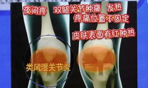 《健康之路》20181130类风湿性关节炎、痛风性滑膜炎、骶髂关节紊乱、髋部疾病