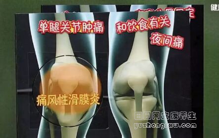 《健康之路》20181130类风湿性关节炎、痛风性滑膜炎、骶髂关节紊乱、髋部疾病