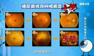 《健康之路》20190227《看出来的健康危机》糖尿病,高血压