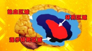 《养生堂》20190403脑中风,脑梗,溶栓,高血压危象,靶器官受损,斜视
