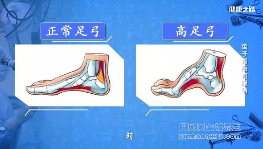 正常足弓和高足弓的区别