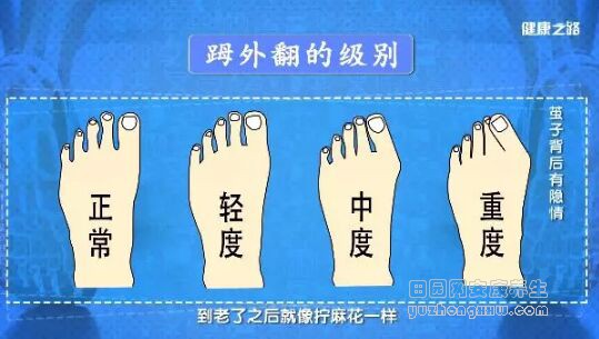 脚拇指外翻的级别