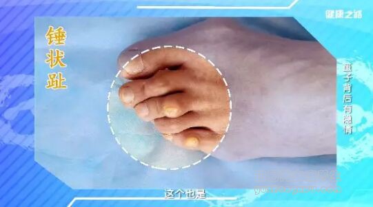 锤状趾