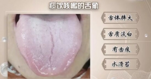 痰饮型咳嗽的症状表现与中医治疗,甘草干姜汤,小青龙汤