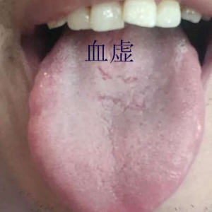 教你形象地认识四种裂纹舌，十种舌象